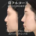 鼻フルコース（鼻複合自家組織移植術）＋鼻プロテーゼ挿入隆鼻術 before画像 サムネイル用