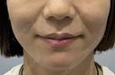 医療ハイフほうれい線 before画像 サムネイル用