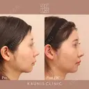 他院鼻中隔延長修正　 before画像 サムネイル用