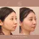 他院鼻中隔延長修正　 after画像 サムネイル用