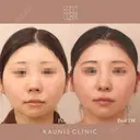 他院鼻中隔延長修正　 after画像 サムネイル用