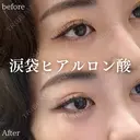 涙袋ヒアルロン酸 before画像 サムネイル用