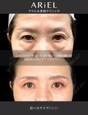 切らない目の下のクマとり・余剰皮膚切除・脂肪注入目の下/ゴルゴライン before画像 サムネイル用