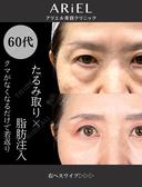 切らない目の下のクマとり・余剰皮膚切除・脂肪注入目の下/ゴルゴライン 90日後 サムネイル用