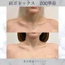 肩ボトックス　200単位 before画像 サムネイル用