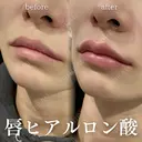 唇ヒアルロン酸 after画像 サムネイル用