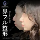 オーダーメイドプロテーゼ＋鼻尖形成3D法＋軟骨移植＋小鼻縮小内側締め付け法＋わし鼻切除＋あごヒアルロン酸※MD式 before画像 サムネイル用