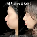オーダーメイドプロテーゼ＋鼻尖形成3D法＋軟骨移植＋小鼻縮小内側締め付け法＋わし鼻切除＋あごヒアルロン酸※MD式 14日後 サムネイル用