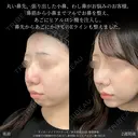 オーダーメイドプロテーゼ＋鼻尖形成3D法＋軟骨移植＋小鼻縮小内側締め付け法＋わし鼻切除＋あごヒアルロン酸※MD式 14日後 サムネイル用