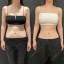 シークレット脂肪吸引お腹 before画像 サムネイル用