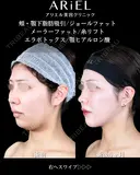 頬・あご下 脂肪吸引 /ジョールファット /メーラーファット/糸リフト /エラボトックス/顎ヒアルロン酸 180日後 サムネイル用