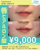 唇ヒアルロン酸 after画像 サムネイル用