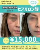 目の下ヒアルロン酸 after画像 サムネイル用