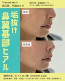 鼻翼基部ヒアル 0日後 サムネイル用