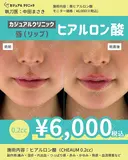 唇ヒアルロン酸 before画像 サムネイル用