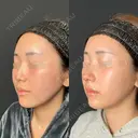 定額鼻整形 before画像 サムネイル用