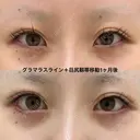 たれ目形成 after画像 サムネイル用