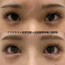 たれ目形成、ナチュラル変化 after画像 サムネイル用