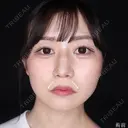 口角挙上 before画像 サムネイル用