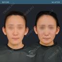 Vライン形成＋外板除去 before画像 サムネイル用