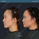 Vライン形成＋外板除去 after画像 サムネイル用