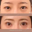 眼瞼下垂手術 before画像 サムネイル用