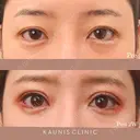 眼瞼下垂手術 after画像 サムネイル用
