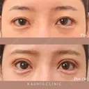 眼瞼下垂手術 after画像 サムネイル用