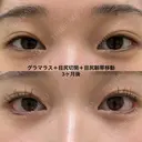 つり目の印象を自然に緩和する、たれ目形成 before画像 サムネイル用