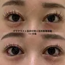 たれ目形成 30日後 サムネイル用