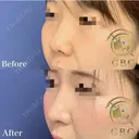【ブタ鼻解消】杉崎医師の鼻複合手術 after画像 サムネイル用