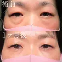 目の下のクマ取り×目の下の脂肪注入×ゴルゴラインの脂肪注入 30日後 サムネイル用