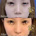 自然な忘れ鼻に・・・ after画像 サムネイル用