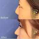 自然な忘れ鼻に・・・ after画像 サムネイル用