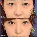 自然な忘れ鼻に・・・ before画像 サムネイル用