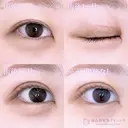 二重埋没 before画像 サムネイル用