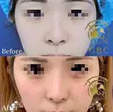 自然な忘れ鼻に・・・ after画像 サムネイル用