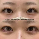 たれ目形成、逆さ睫毛気味でもしっかり下げて丸いカーブに before画像 サムネイル用