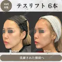テスリフト before画像 サムネイル用