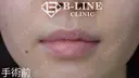 【口唇縮小術（下）】1ヵ月後 before画像 サムネイル用