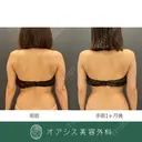 コンプリート脂肪吸引【上腕全周〜お背中の一部】🌴形成外科専門医がご対応✨ after画像 サムネイル用