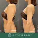 コンプリート脂肪吸引【上腕全周〜お背中の一部】🌴形成外科専門医がご対応✨ after画像 サムネイル用