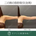 コンプリート脂肪吸引【上腕全周〜お背中の一部】🌴形成外科専門医がご対応✨ before画像 サムネイル用