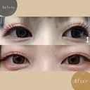涙袋ヒアルロン酸 after画像 サムネイル用