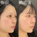 ヒアルロン酸注入（鼻/顎） after画像 サムネイル用