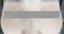 IPL光治療でシミ・くすみのない透明肌✨ after画像 サムネイル用