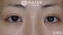 【BL式韓流目頭切開術】3ヵ月後 before画像 サムネイル用