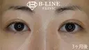 【BL式韓流目頭切開術】3ヵ月後 after画像 サムネイル用