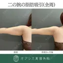 コンプリート脂肪吸引【上腕全周〜背中の一部】 after画像 サムネイル用