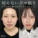 切らないクマ取り＋ヒアルロン酸（目の下・ゴルゴライン） before画像 サムネイル用